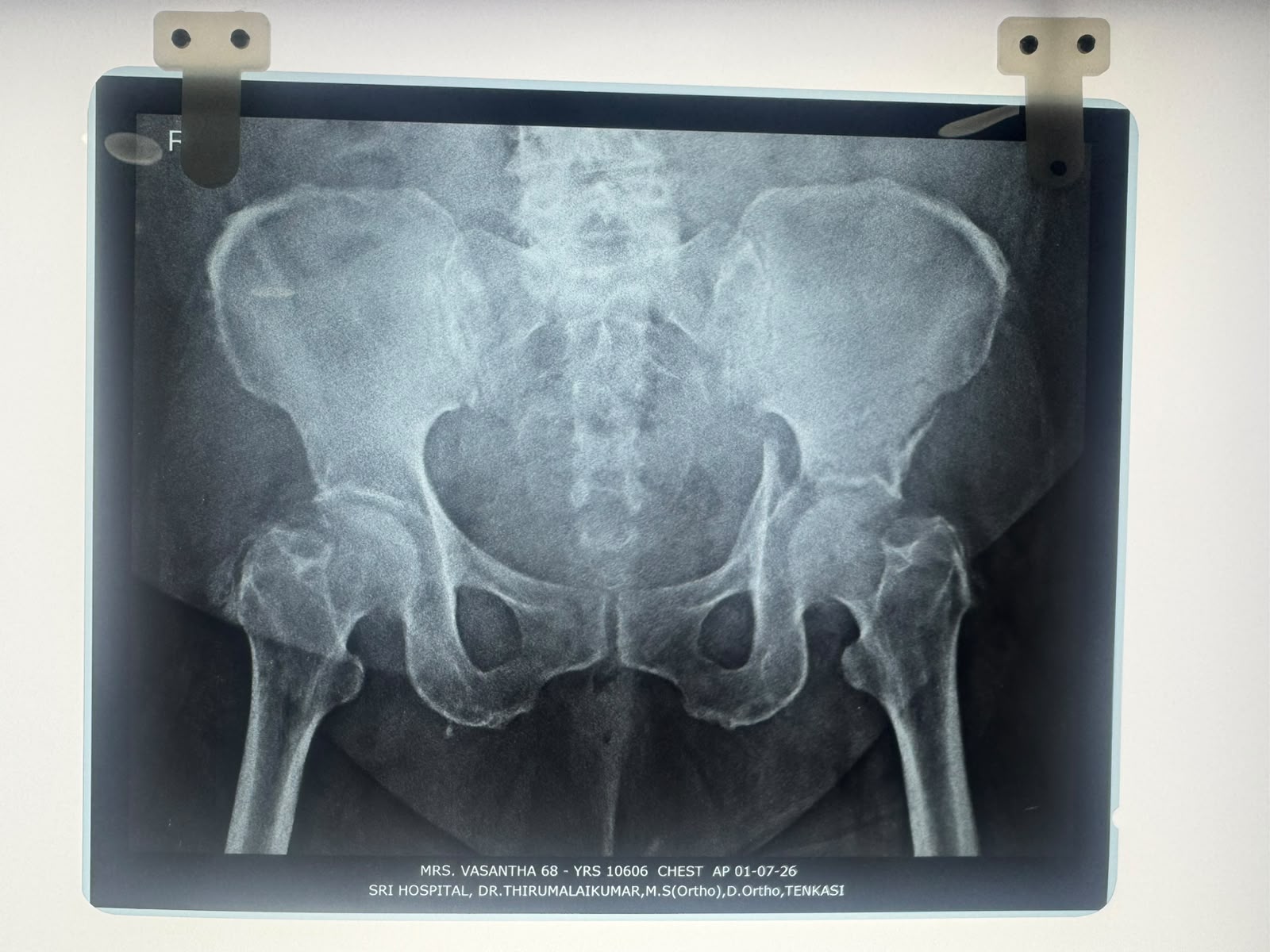 Before hip fracture fixation X-ray